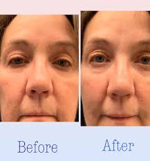 First time with contrast! It took just 30 minutes. Im amazed with the  results