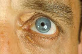 Image result for xanthelasma of eyelid