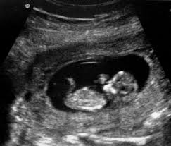 De obicei, pe durata sarcinii, excitabilitatea este mai ridicata, datorita nivelurilor hormonale crescute. Ecografiile In SarcinÄƒ Ghid Complet Sfatulmamicilor Ro