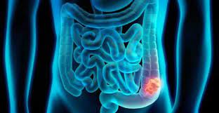 When colon cancer is detected in its early stages, it may not have even caused symptoms. Colon Cancer Symptoms Warning Signs Therapy Prognosis