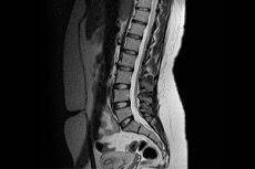 O scanare lombară prin rezonanță magnetică (rmn) utilizează energie de la magneți puternici pentru a crea imagini ale părții inferioare a coloanei vertebrale (coloana lombară). Rmn A Coloanei Vertebrale Lombare Cum Se Face Ceea Ce AratÄƒ Competent Despre SÄƒnÄƒtate Pe Ilive