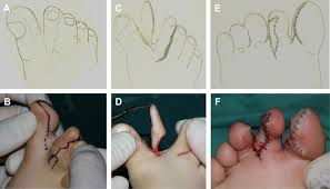 Image result for Syndactyly