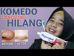 Cara Menghilangkan Komedo Secara Alami Dengan Pasta Gigi Youtube