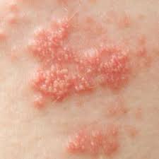 Skin Rash 68 Pictures Causes And Treatments