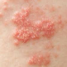 skin rash 68 pictures causes and treatments