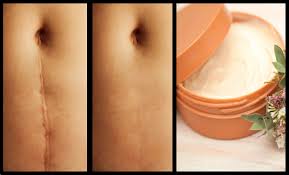 5 Alternativas Naturales Para Combatir Las Cicatrices Remedios Para Cicatrices Tratamientos Para Cicatrices Remedios Caseros Para Cicatrices