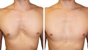 This condition progresses throughout childhood and is sometimes referred to as funnel chest. Pectus Excavatum Resultat Avant Apres De L Operation Par Implants 3d