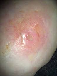 Entzundete Wunde Unter Der Brust Schaut Euch Das Mal An Bild Eingefugt Entzundung