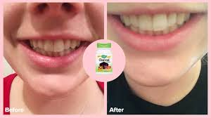 How often should you use rice water? Rice Water For Hair How To Make It And Benefits