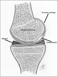 Design, harvest, and inset of trimmed great toe for thumb reconstruction in mutilated hand References In Diagnosis And Management Of Chondral Delamination Injuries Of The Knee The Knee