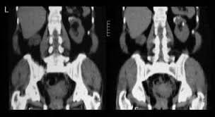 Image result for Nephrolithiasis Imaging