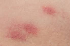 Image result for flea bites