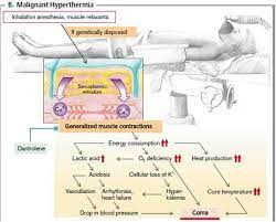 Hiperthermia Malignant Hyperthermia Vasodilation Acidosis