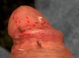 Mosquito bite cock - Creature Comforts | MOTHERLESS.COM ™