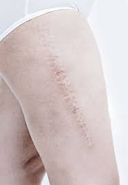 Patientenbeispiele Fur Die Narbentherapie Scaremedy