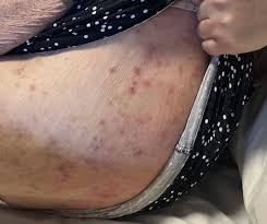 Image result for scabies bite