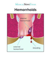 Image result for Hemorrhoid