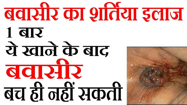 Image result for bawasir ka ilaj"