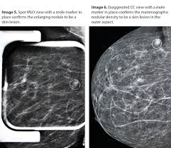 The look of breast cancer on a mammogram. A Radiologist S Perspective On The Importance Of Marking Moles In Mammography Beekspeak The Blog Of Beekley Medical