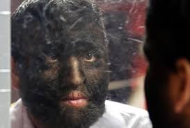Hypertrichosis, sometimes called werewolf syndrome is a very rare condition, with fewer than 100 cases documented worldwide. Werewolf Man Jesus Aceves Looks Up To Face The Truth News Emirates24 7