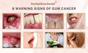 Image result for gum cancer symptoms
