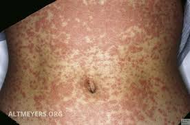 That true sensitization can occur within mononucleosis infectiosa patients suffering from amoxicillin rash. Mononukleose Infektiose Altmeyers Enzyklopadie Fachbereich Dermatologie