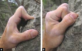 The two prime movers of grip force are flexor digitorum superficialis (fds) and flexor digitorum profundus (fdp). Traumatic Flexor Tendon Injuries Sciencedirect