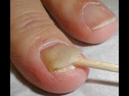 cure toenail fungus