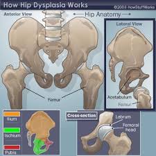 Hip Dysplasia Overview Hip Dysplasia Hip Anatomy Developmental Dysplasia Of The Hip