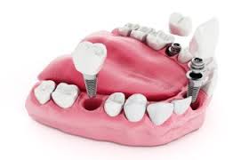 With some cases, however, two or more scheduled appointments may be required. Crown After Root Canal Therapy