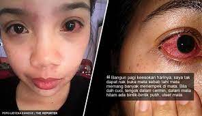 Salah satu fungsi utamanya adalah melindungi permukaan meskipun mata berair adalah hal yang wajar, namun akan menjadi masalah jika mata anda terlalu banyak memproduksi air mata, atau air mata. Mata Tak Dapat Buka Pedih Berair Sakit Sampai Kepala Dan Nyaris Buta Disebabkan Ulser Mata The Reporter