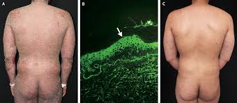 Image result for Pemphigus