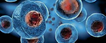 CLINICAL NEWS | Promising Outcomes Found with Stem Cell Transplant for  Fanconi Anemia-related Leukemia, MDS – TIF