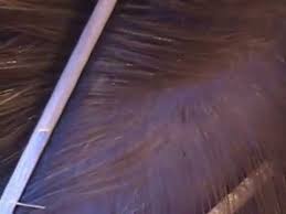 But you can also see lighter lice on a dark head and. How To Get Rid Of Lice What Do Lice And Nits Look Like In The Hair Youtube