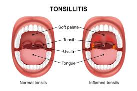 Image result for Tonsillitis