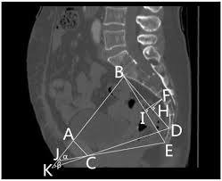 Image result for Pelvimetry