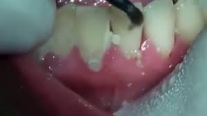 Check spelling or type a new query. China Electric Dental Calculus Remover Tartar Scraper Tartar Remover Ultrasonic Teeth Cleaning Tool Teeth Plaque China Dental Calculus Remover Dental Scraper