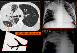 Image result for Air Bronchogram