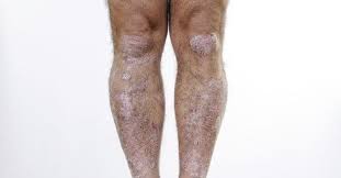 Understanding The Potential Causes Of Dry Itchy Skin Gm