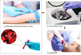 The engagement as a prp must be in any premises listed in the second schedule (can be obtain in the minister of health website) in order to be entitled to apply for full registration. Platelet Rich Plasma Therapy Prp Cost Gem Clinic