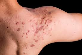 Adapalene is a topical medication for acne treatment. Acne Scars Reduced Prevented With Topical Adapalene Benzoyl Peroxide Dermatology Advisor