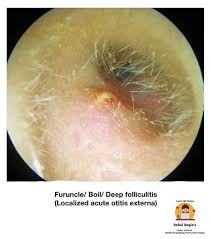 Image result for Acute Otitis Externa