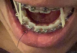 They cut them off with clippers. I M Scheduled To Have My Braces Taken Off Next Month But I Noticed My Bottom Teeth Are Not Alligned Properly Obviously My Ortho Saw It But Apparently It Won T Be Fixex By
