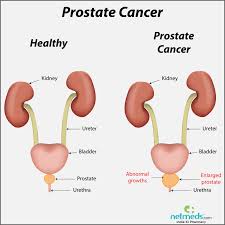 Older patients with cancer may have both dementia and delirium. Prostate Cancer Causes Symptoms And Treatment Netmeds