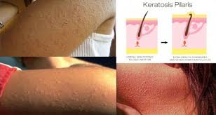 You Can Now Put An End To Keratosis Pilaris Chicken Skin Keratosis Pilaris Chicken Skin Remedy Keratosis Pilaris Treatment