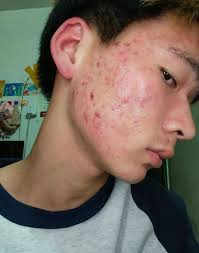 When that pimple gets in the way💞💞💞