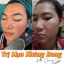 Sale 70% nhân dịp Noel. #199k. Sạch mụn thâm sáng da