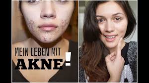 Die inhaltsstoffe sind nichts besonderes und unterscheiden sich kaum von anderen ölen zur narbenbehandlung. Mein Leben Mit Akne Vorher Nachher Tipps Betterskinwithanna Youtube