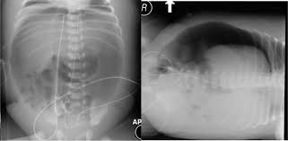 Image result for Necrotizing Enterocolitis