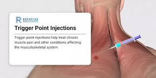 Image result for Trigger Point